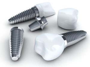 Dental Implants in Torrensville, Thebarton, Mile End, Hilton, Cowandilla, Brooklyn Park, Underdale, Hindmarsh, Welland, Allenby Gardens, Flinders Park, Western Adelaide SA